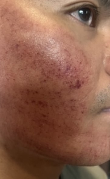 Micro-needling recovery, Day 1