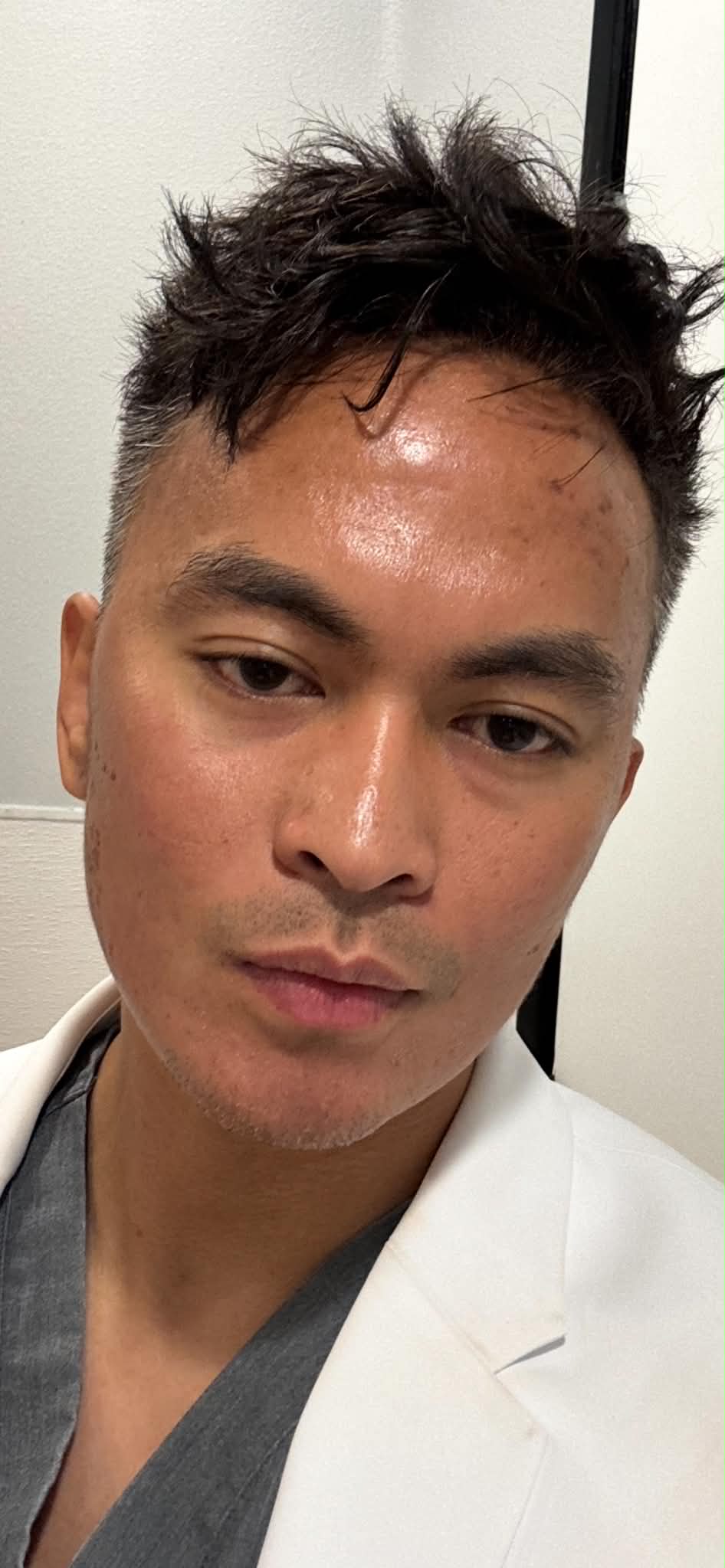 Micro-needling recovery, Day 4